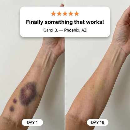 💥75K+ SOLD💕- Siromis® Bruise Repair & Skin-Strengthening Cream